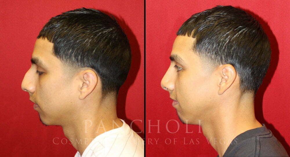 male nose job las vegas before and after 