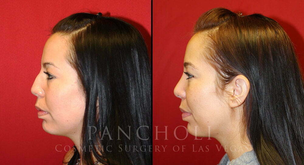 nose job las vegas before and after 