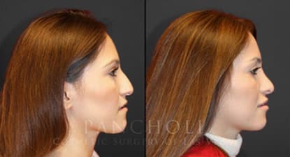 facial cosmetic surgery result - Pancholi