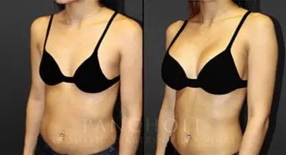 breast cosmetic surgery result - Pancholi