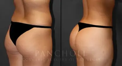 body cosmetic surgery result - Pancholi