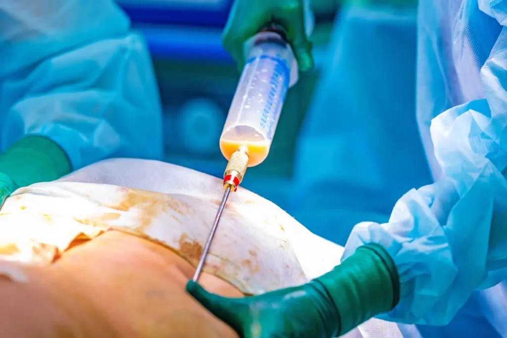 Close-up of liposuction syringe removing fluid during procedure