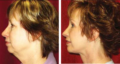 what is the best age for face lift surgery, before and after pictures of facelift las vegas