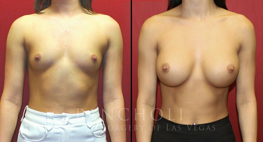 Las Vegas Breast Augmentation