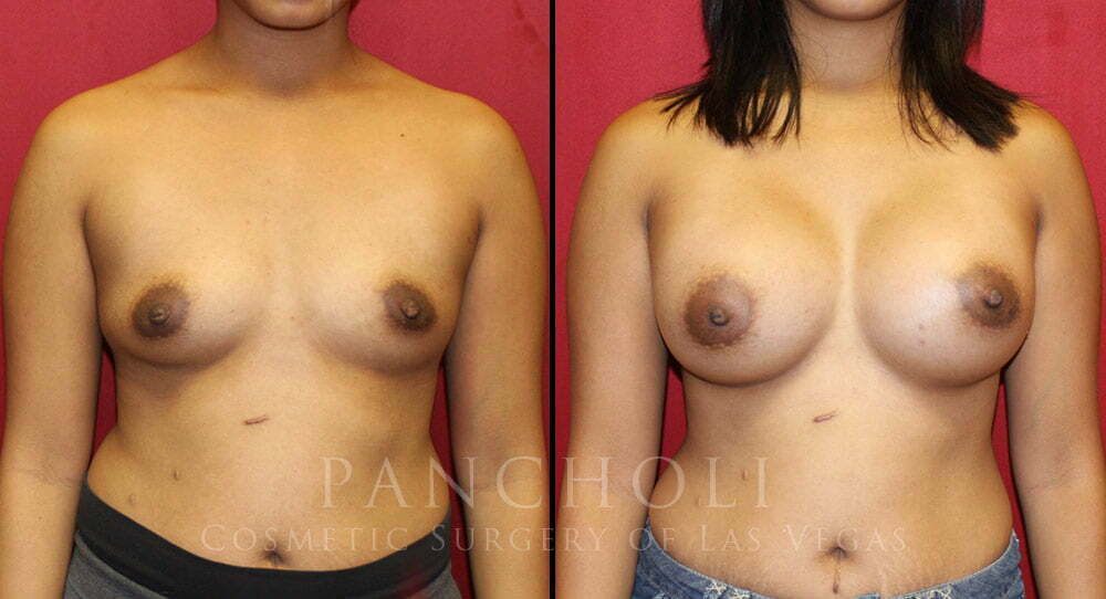Breast Augmentation 5278