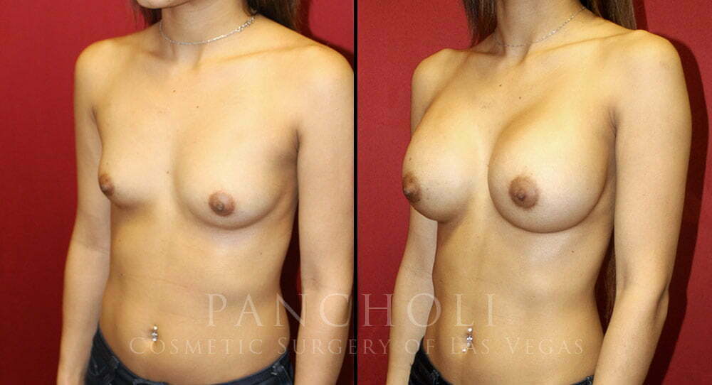 Las Vegas Breast Augmentation