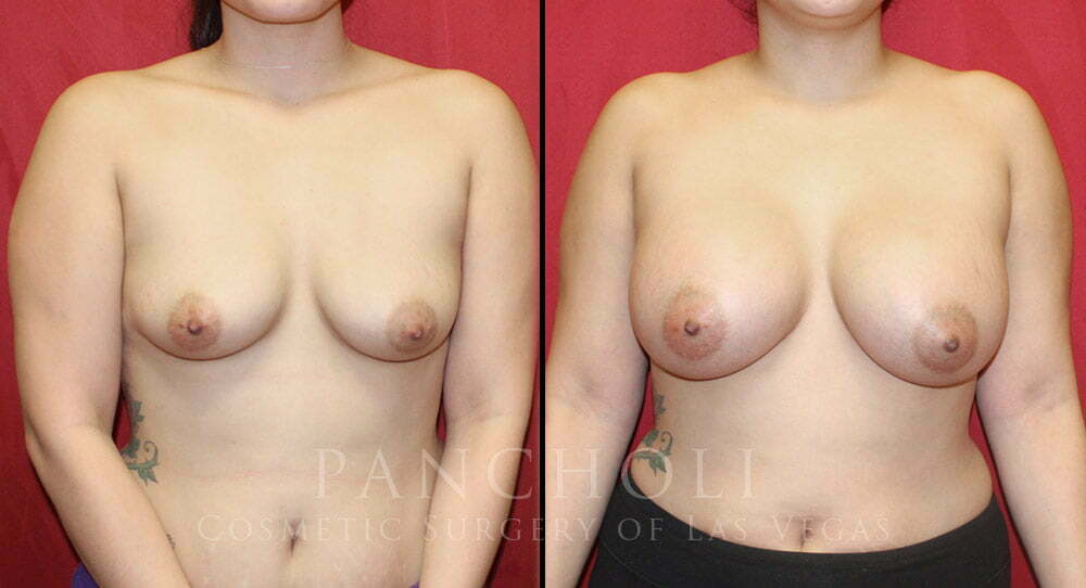 Breast Augmentation 5346