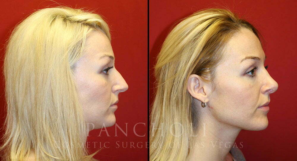 Rhinoplasty Patient 4430 Cosmetic Surgery of Las Vegas