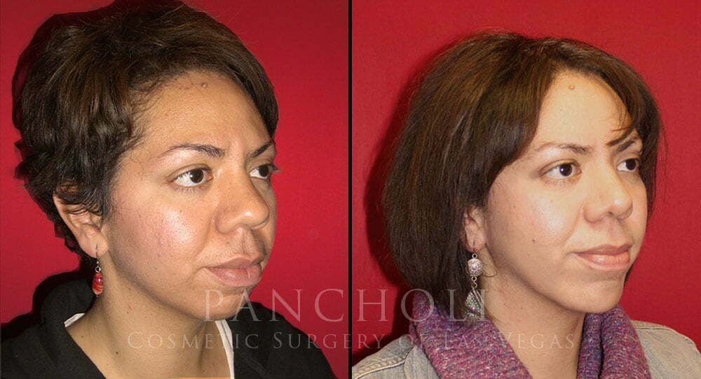 Rhinoplasty 4024 Cosmetic Surgery of Las Vegas