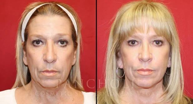 Face Lift Before and After Gallery