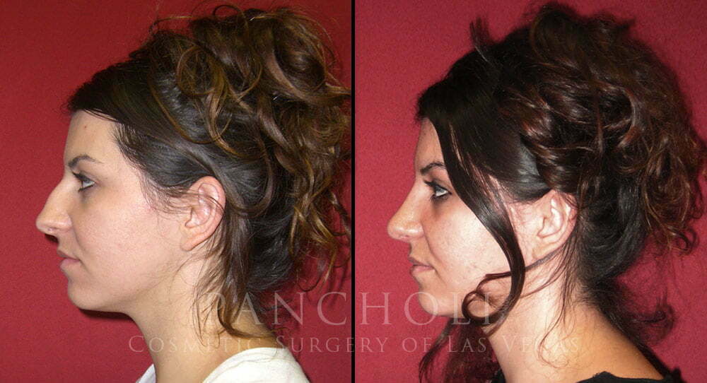 nose job las vegas before and after 
