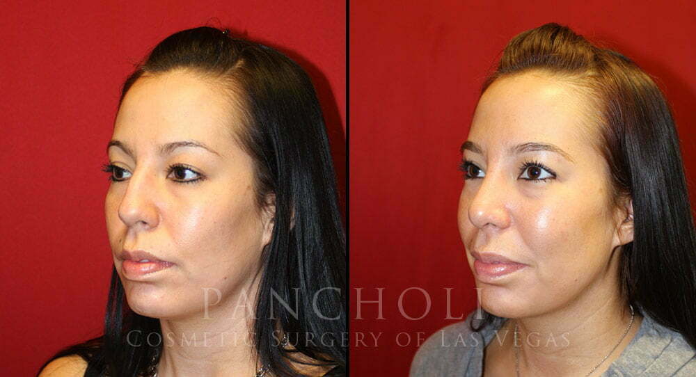 Rhinoplasty 3903 Cosmetic Surgery of Las Vegas