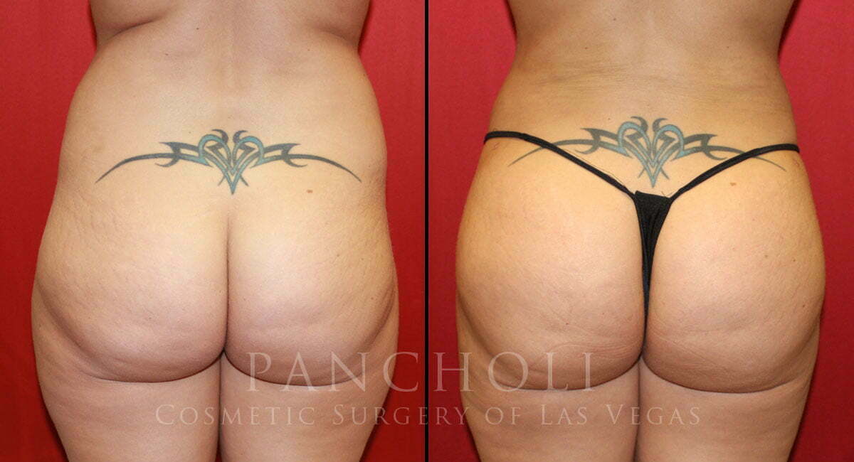 Brazilian Butt Lift and Liposuction 4195