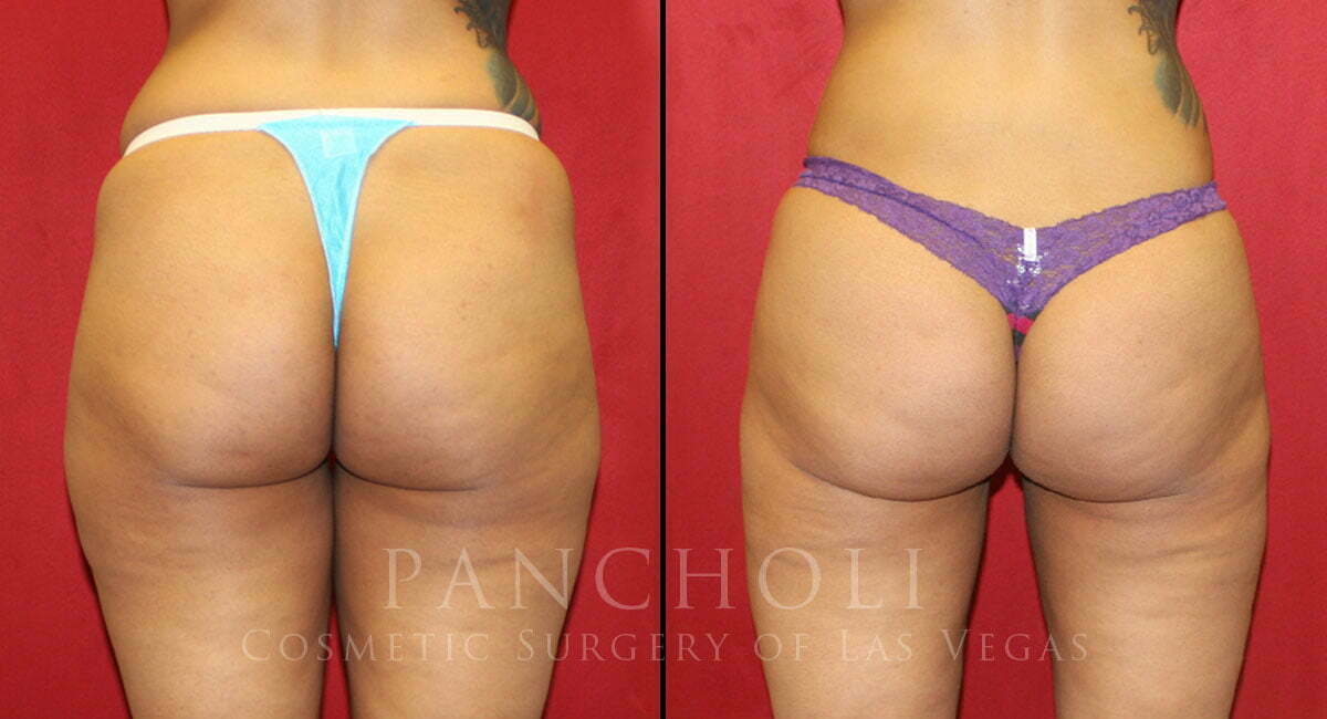 Brazilian Butt Lift and Liposuction 5953