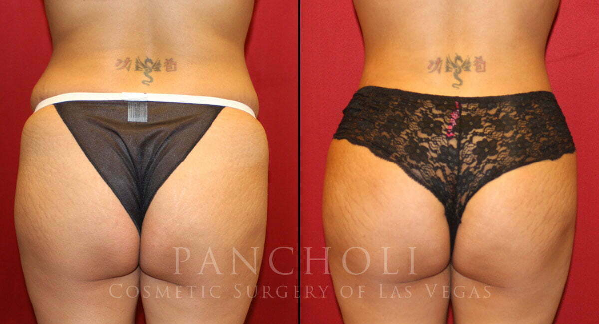 Brazilian Butt Lift, Liposuction, and Tummy Tuck 6042
