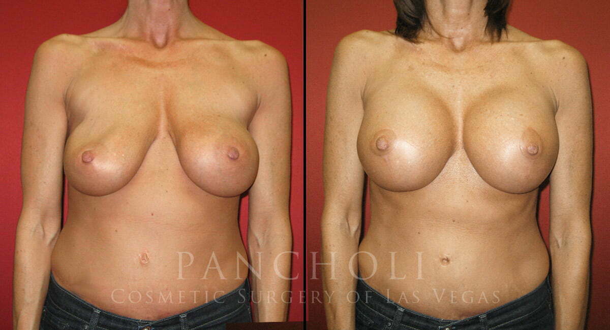 Breast Augmentation with Lift 1982
