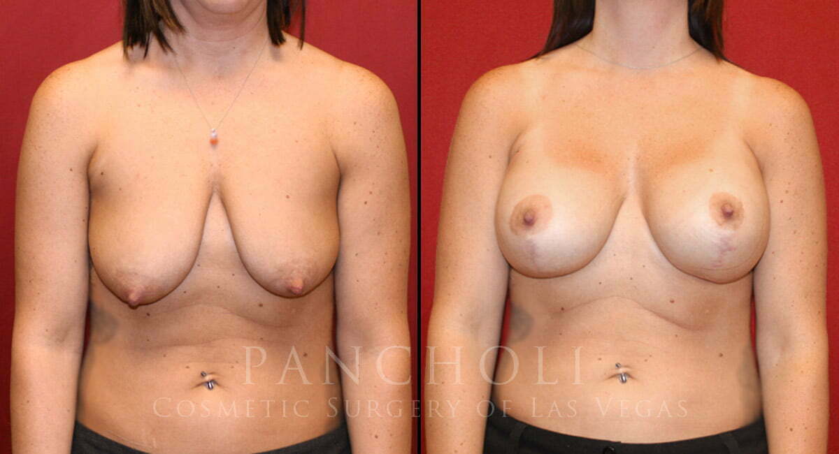 Breast Augmentation with Lift 5434