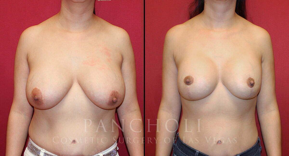 Breast Augmentation with Lift 5920