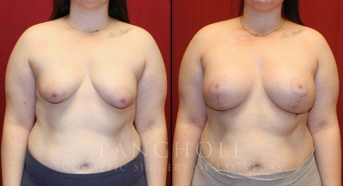 Breast Augmentation with Lift 6830