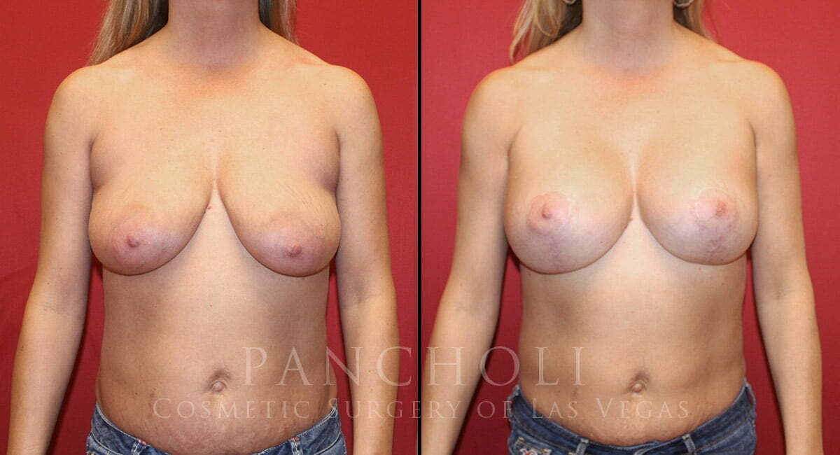 Breast Augmentation with Lift 7188