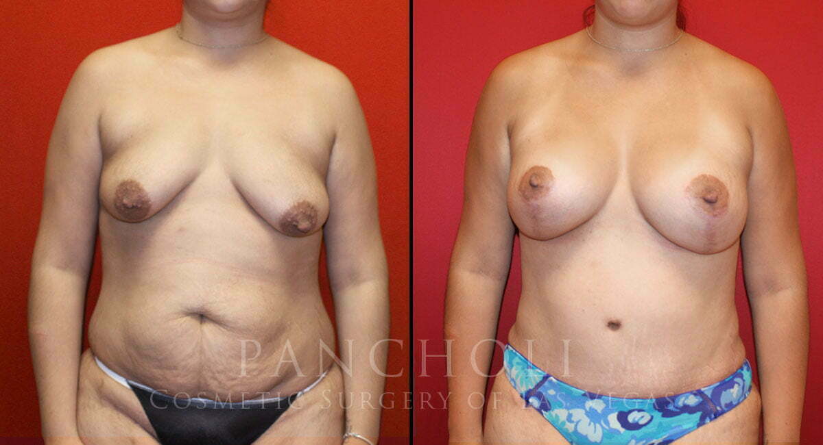 Breast Augmentation with Lift  2288