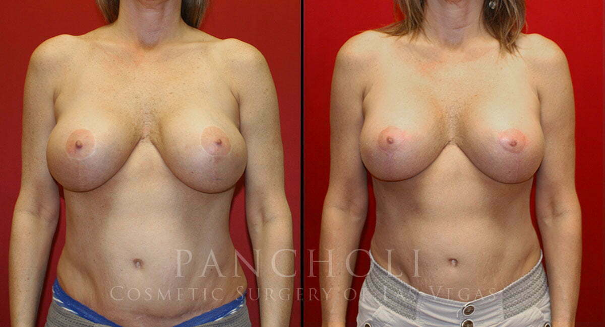 Breast Augmentation with Lift 5065
