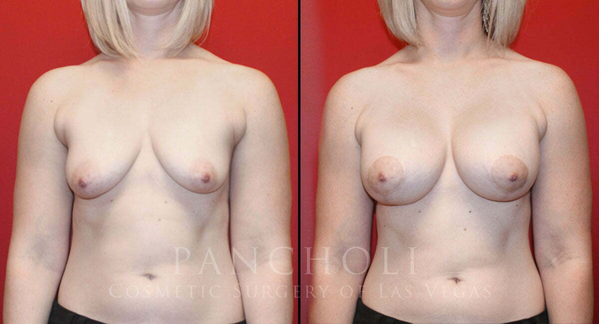 Breast Augmentation with Lift 6829