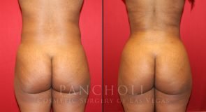 Brazilian Butt Lift and Liposuction 6032