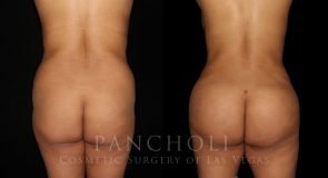 Brazilian Butt Lift, Liposuction, and Tummy Tuck 7963
