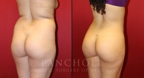 Liposuction Patient #8996