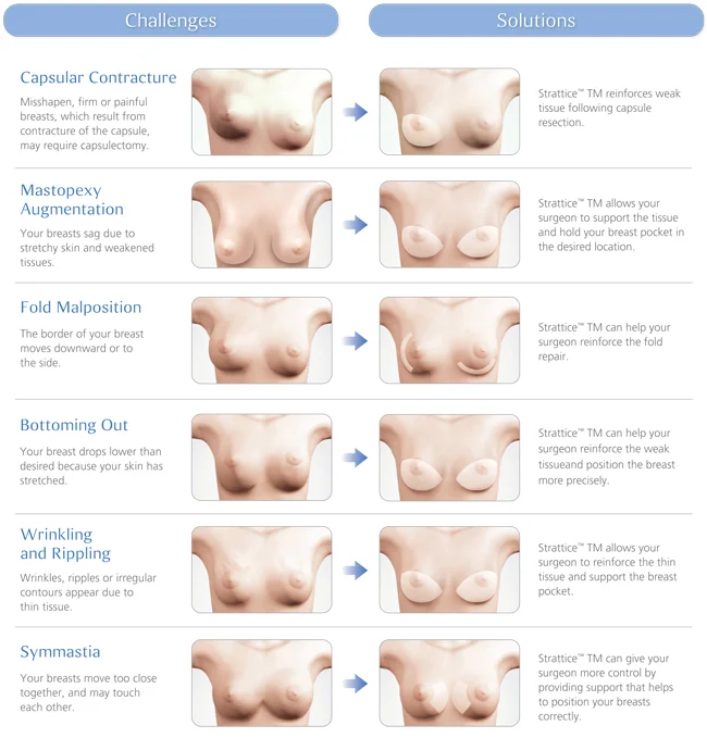 Strattice Tissue Matrix and Galatea Surgical Mesh for Breast