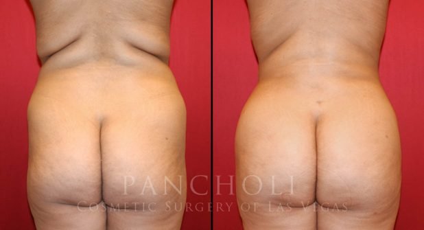 Fat Transfer Before and After Gallery