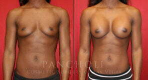 Breast Augmentation 6161
