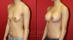breast-augmentation-24b