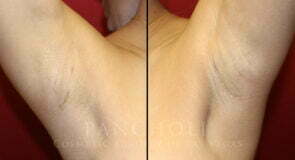 breast-augmentation-24d