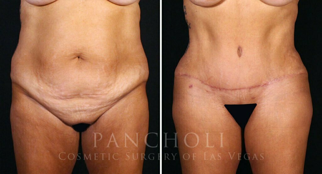 abdominoplasty-liposuction-brazillian-butt-lift-21308-a