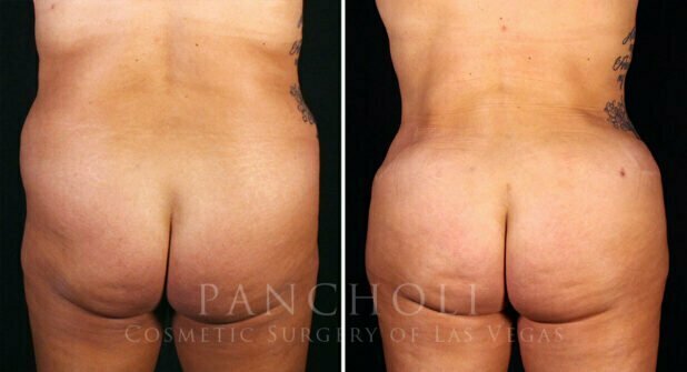 Tummy Tuck Before and After Gallery