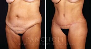 abdominoplasty-liposuction-brazillian-butt-lift-21308-lb