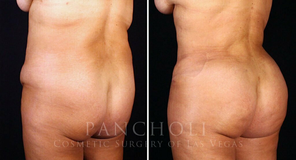 abdominoplasty-liposuction-brazillian-butt-lift-21308-ldc