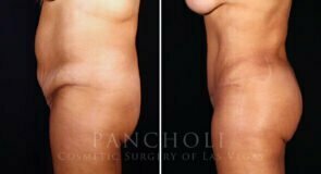 abdominoplasty-liposuction-brazillian-butt-lift-21308-ls