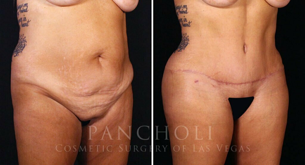 abdominoplasty-liposuction-brazillian-butt-lift-21308-rb