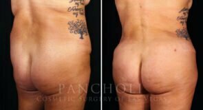 abdominoplasty-liposuction-brazillian-butt-lift-21308-rdc