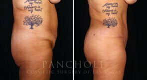 abdominoplasty-liposuction-brazillian-butt-lift-21308-rs