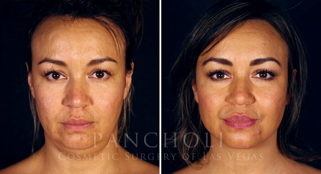 Photo of patient Before (left) and After (right) submentoplasty and buccal fat removal.