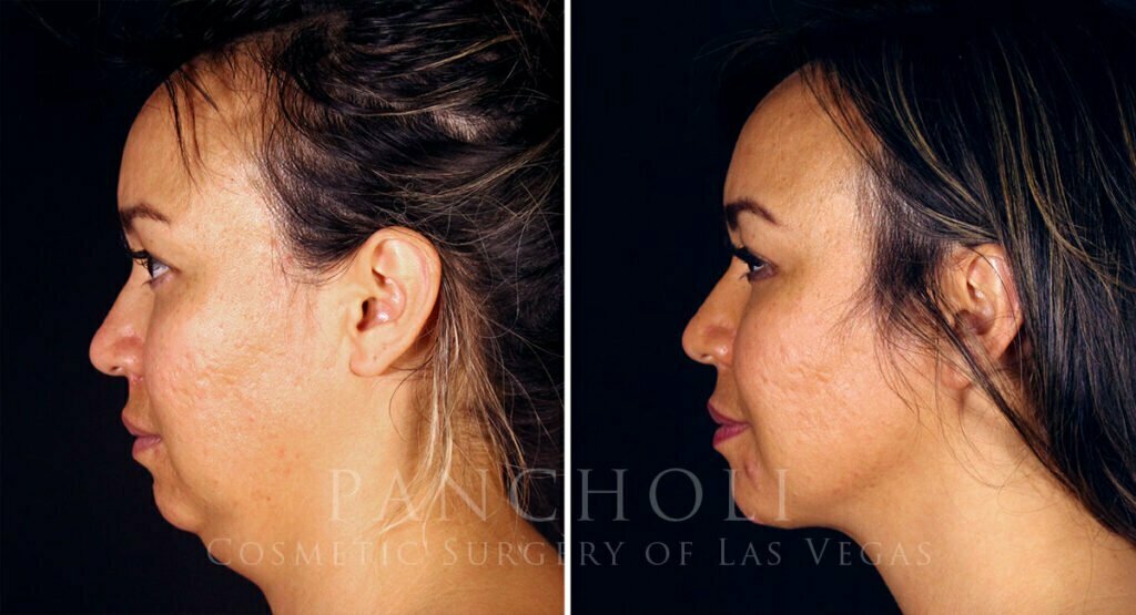 Side profile photo of patient Before (left) and After (right) submentoplasty and buccal fat removal. 