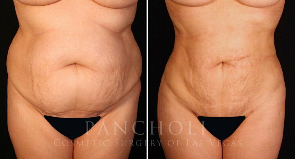 liposuction-21220-a