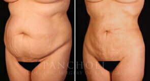 liposuction-21220-lb