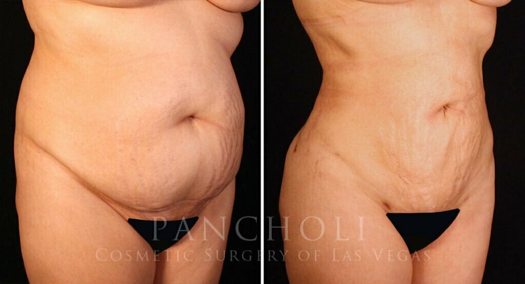 liposuction-21220-rb