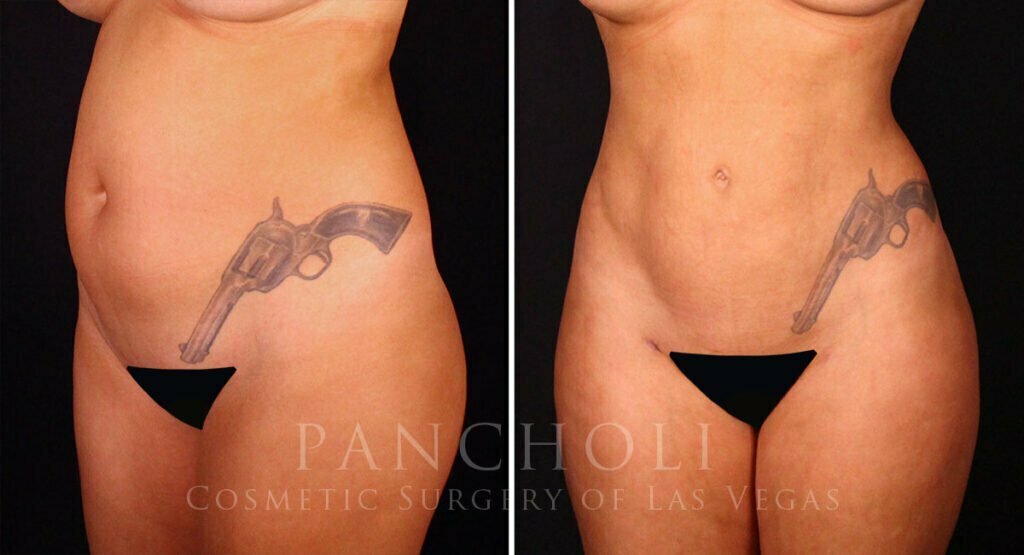 liposuction-21252-lb
