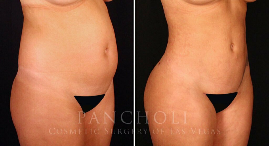 liposuction-21252-rb